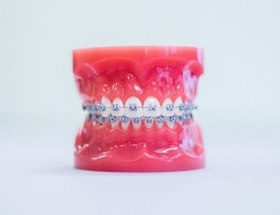 Metal Braces treatment at Evrigenis Orthodontics image