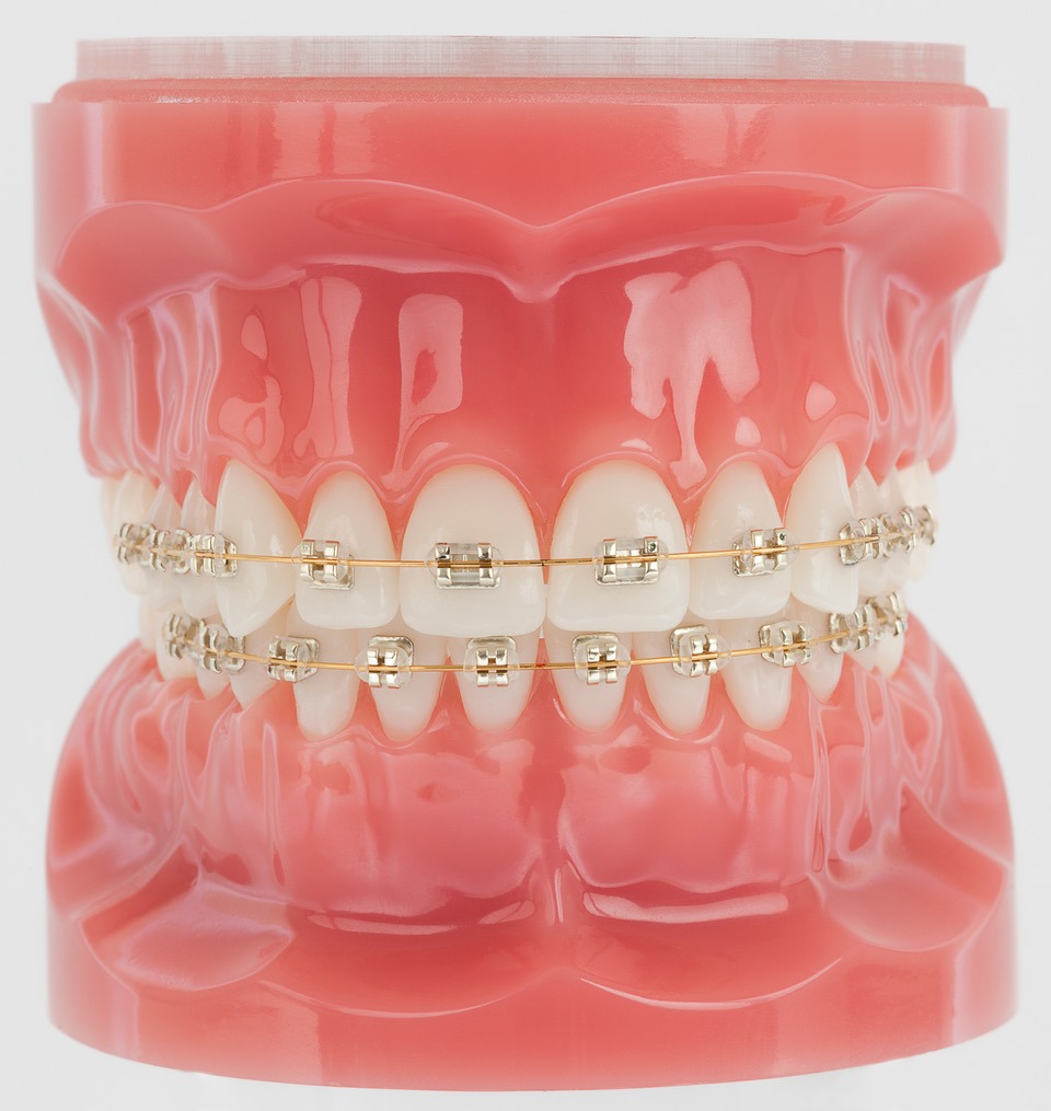 Iconix Gold Braces