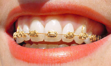 Iconix Gold Braces